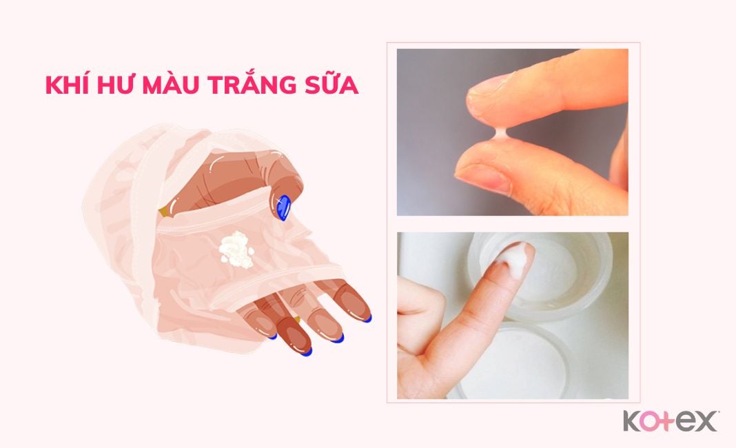 Chậm Kinh Ra Khí Hư Màu Trắng Sữa Có Phải Mang Thai Không?